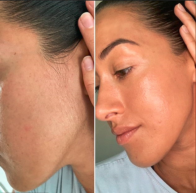 Say Goodbye to Hyperpigmentation: Hollywood Browzer's Guide to Flawless Skin