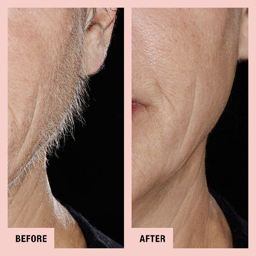 Peach fuzz before and after Clearance