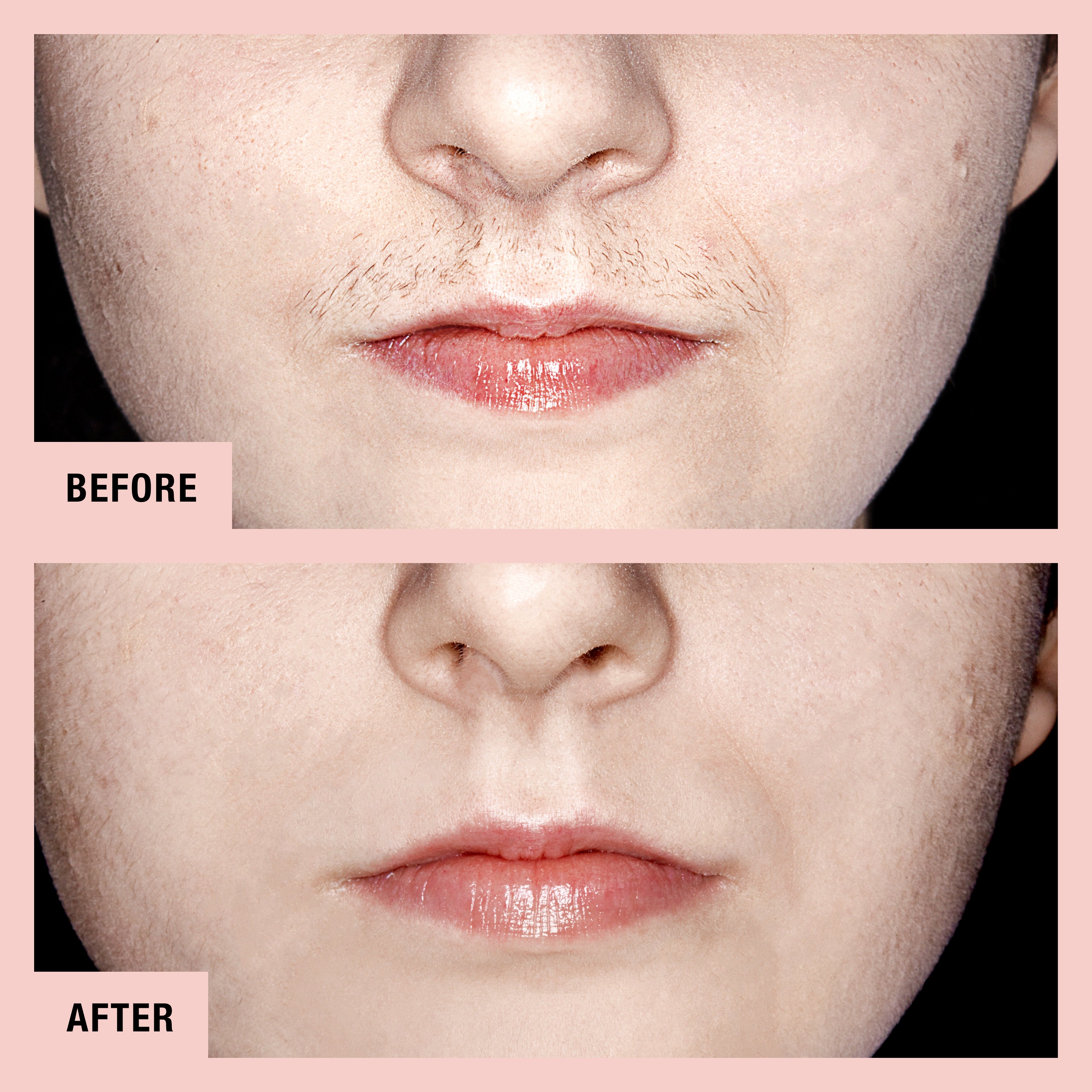 Results Upper Lip Hair Remover Gentle Lip Hair Removal Results