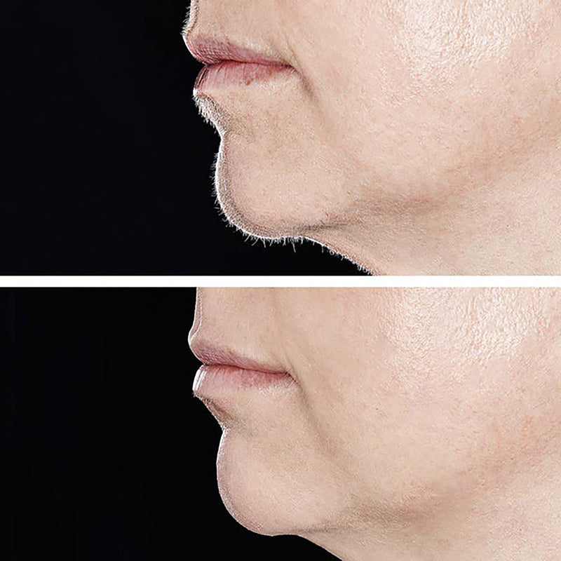 Before and after on Chin 